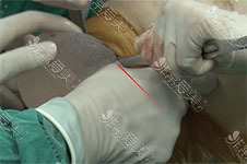 揭秘韩国隆胸手术细节，江南kbeauty提供无触碰气压植入假体