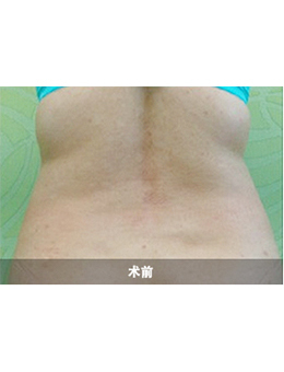 韩国4ever整形外科吸脂瘦腹部手术对比案例_术前