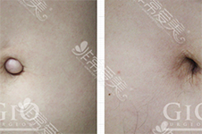 肚脐眼整形案例图片曝光,韩国GIO医院肚脐整形效果看得见！