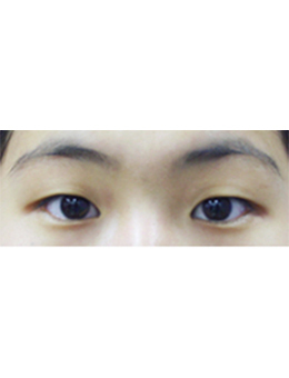 韩国4ever整形外科双眼皮手术对比案例_术前