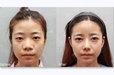 韩国Nano、trend、Cocoline隆鼻医院哪个好?隆鼻日记对比图有吗?