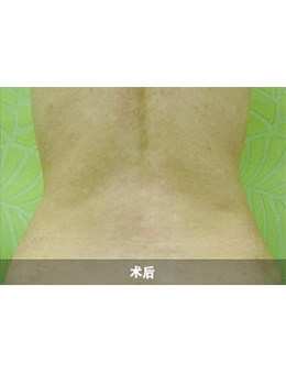 韩国4ever整形外科吸脂瘦腹部手术对比案例_术后