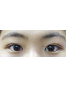 韩国4ever整形外科双眼皮手术对比案例_术后
