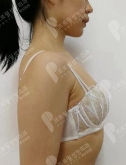 韩国普罗菲耳隆胸手术案例图片