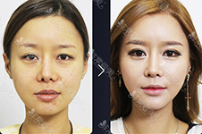 双眼皮眼部提肌手术危害分析，韩国k-beauty要用非切开避免！