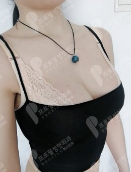 韩国Profile-韩国普罗菲耳隆胸手术案例图片