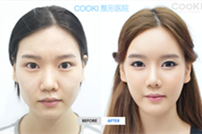 韩国本爱医院与cooki医院面部轮廓案例曝光，术后效果超自然