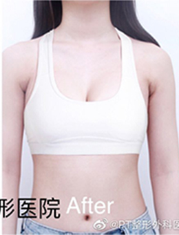 韩国PT整形外科蓓拉假体隆胸对比