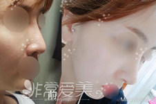 韩国MIND整形外科缩鼻翼会留疤吗？缩小鼻翼需要多少钱？