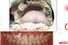 昆明美奥即刻负重种植病例分享:牙龈萎缩牙周病可以做种植