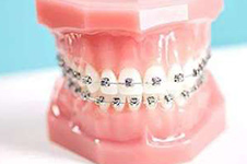 牙齿矫正步骤有人了解吗？矫正牙齿多久加紧一次？