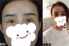 广州哪个医生修复双眼皮好 我选择韩妃李光琴做不对称修复