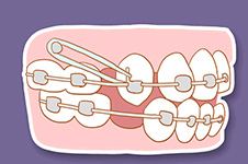 牙齿隐形矫正和金属固定矫正哪个更好？