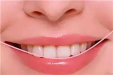笑起来不好看？郑州唯美口腔牙齿正畸让你的笑更有美感！