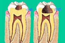 口腔医生在线科普:牙齿龋坏到这个程度,就需要做根管治疗了