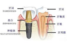 种植牙可以换烤瓷冠吗？种植牙牙冠全瓷和烤瓷哪种好？