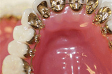 6千元在广州美莱口腔医院做的舌侧矫正，拆牙套后美出天际