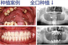 瑞士iti種植牙永久嗎做完后悔了?瑞士牙齒種植體iti價(jià)格貴嗎