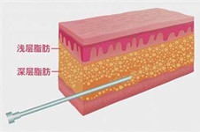 溫州哪個醫(yī)院環(huán)形抽脂效果好,價格公道手術安全這幾家不錯