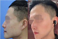 上海哪个医生做下颌角整形好?仁爱刘先超轮廓手术经历分享!