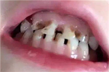 乳牙出现龋齿需要补牙吗？补牙的话一颗多少钱？