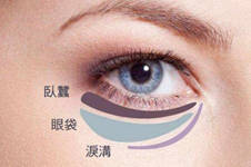 广州去眼袋手术哪家医院技术好？不开刀去眼袋靠谱吗
