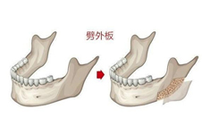 下頜角整形為什么要劈外板？劈外板后臉會(huì)垮嗎？