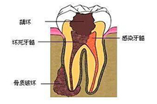 北京根管治療價(jià)格公開(kāi)，根管治療一顆牙費(fèi)用竟然要這么多