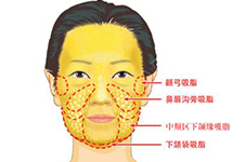 面部吸脂后皮下粘连都有哪些症状?粘连怎么治疗剥离看这儿!