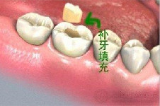 在郑州补牙大概要多少钱？郑州哪里补牙好又便宜？