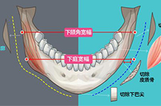 下颌角切没了可以修复么?下颌角被切多了要修复该怎么做?