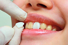 门牙尽量不做全瓷牙，牙医圈都流传哪些行业秘密？