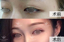 潍坊做双眼皮手术厉害的医院公布,靠谱正规好口碑!