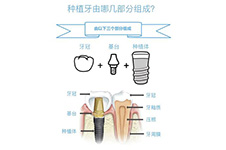 郑州种植牙医院哪个好,在民营医院做一颗种植牙大概多少钱?
