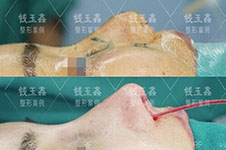 上海鼻修复医生推荐:失败疤痕感染挛缩鼻找这几位错不了!