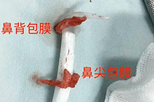 上海鼻修复比较好的医院盘点,高难度鼻修复就找这几家！