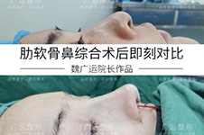 郑州出名鼻整形医生有几位,盘点隆鼻好的医生附手术多少钱!