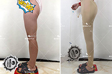 真人案例:上海丽质整形直腿成形术变化经过,腿围立减8cm！