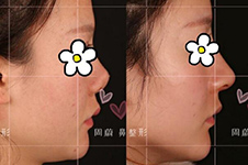 郑州鼻修复医生推荐几位，看案例分析各自隆鼻优势！