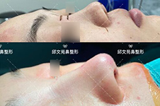 上海肋骨鼻医生排行公布，这三位做鼻子术后真实不显假！