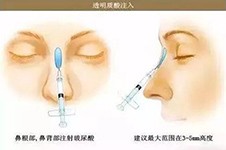 上海玻尿酸隆鼻哪个医生塑形好,针打的自然有美感?