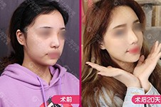 上海做面部吸脂厉害的医生汇总，还附带拿手面吸案例！