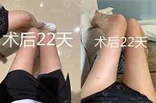 上海华美何斌吸脂怎么样，看真人大腿吸脂1~20天恢复案例！