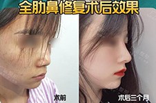 魏广运做鼻子怎么样，公布真人案例看其隆鼻风格如何！