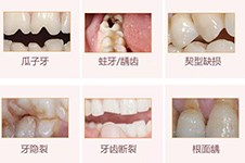 在东莞补牙一般多少钱,公布详细价格表还附带补牙好医院!