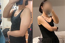 韩国手臂吸脂亲身经历，包含吸脂前后一个月改善效果！