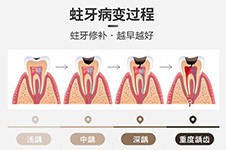 石家庄补牙哪里便宜又好,在石家庄补牙大概要多少钱一颗?