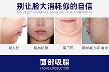 上海脸部吸脂医院不错的有几家,吸脂瘦脸一般价格要多少?