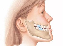 成人牙齿反颌怎么矫正？手术要多久价格一般多少钱？