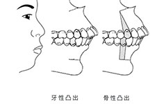 骨性凸嘴正颌手术费用公布,详细价格表揭秘正颌要多少钱!